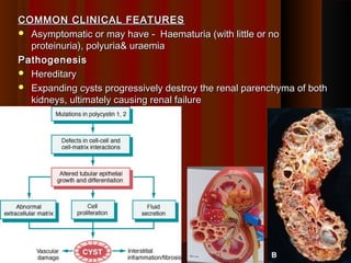 COMMON CLINICAL FEATURESCOMMON CLINICAL FEATURES
 Asymptomatic or may have - Haematuria (with little or noAsymptomatic or may have - Haematuria (with little or no
proteinuria), polyuria& uraemiaproteinuria), polyuria& uraemia
PathogenesisPathogenesis
 HereditaryHereditary
 Expanding cysts progressively destroy the renal parenchyma of bothExpanding cysts progressively destroy the renal parenchyma of both
kidneys, ultimately causing renal failurekidneys, ultimately causing renal failure
2828
 