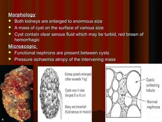 MorphologyMorphology
 Both kidneys are enlarged to enormous sizeBoth kidneys are enlarged to enormous size
 A mass of cyst on the surface of various sizeA mass of cyst on the surface of various size
 Cyst contain clear serous fluid which may be turbid, red brown ofCyst contain clear serous fluid which may be turbid, red brown of
hemorrhagichemorrhagic
MicroscopicMicroscopic
 Functional nephrons are present between cystsFunctional nephrons are present between cysts
 Pressure ischaemia atropy of the intervening massPressure ischaemia atropy of the intervening mass
2929
 