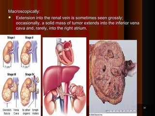 Macroscopically:Macroscopically:
 Extension into the renal vein is sometimes seen grossly;Extension into the renal vein is sometimes seen grossly;
occasionally, a solid mass of tumor extends into the inferior venaoccasionally, a solid mass of tumor extends into the inferior vena
cava and, rarely, into the right atrium.cava and, rarely, into the right atrium.
3434
 