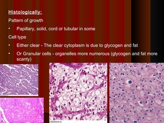 Histologically:
Pattern of growth
• Papillary, solid, cord or tubular in some
Cell type
• Either clear - The clear cytoplasm is due to glycogen and fat
• Or Granular cells - organelles more numerous (glycogen and fat more
scanty)
3535
 