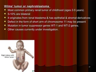Wilms' tumor or nephroblastomaWilms' tumor or nephroblastoma
 Most common primary renal tumor of childhood (ages 2-5 years).Most common primary renal tumor of childhood (ages 2-5 years).
 5-10% are bilateral5-10% are bilateral
 It originates from renal blastema & has epithelial & stromal derivativesIt originates from renal blastema & has epithelial & stromal derivatives
 Defect in the form of short arm of chromosome 11 may be presentDefect in the form of short arm of chromosome 11 may be present
 Mutation in tumor suppressor genes WT-1 and WT-2 genes.Mutation in tumor suppressor genes WT-1 and WT-2 genes.
 Other causes currently under investigation.Other causes currently under investigation.
3737
 