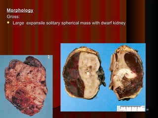 MorphologyMorphology
Gross:Gross:
 Large expansile solitary spherical mass with dwarf kidneyLarge expansile solitary spherical mass with dwarf kidney
3838
 
