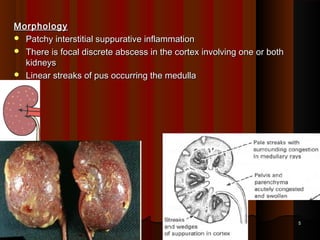 MorphologyMorphology
 Patchy interstitial suppurative inflammationPatchy interstitial suppurative inflammation
 There is focal discrete abscess in the cortex involving one or bothThere is focal discrete abscess in the cortex involving one or both
kidneyskidneys
 Linear streaks of pus occurring the medullaLinear streaks of pus occurring the medulla
55
 