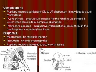 ComplicationsComplications
 Papillary necrosis particularly DM & UT obstruction it may lead to acutePapillary necrosis particularly DM & UT obstruction it may lead to acute
renal failurerenal failure
 Pyonephrosis – suppurative exudate fills the renal pelvis calyces &Pyonephrosis – suppurative exudate fills the renal pelvis calyces &
ureter when there is total complete obstructionureter when there is total complete obstruction
 Perinephric abscess – suppurative inflammation extends through thePerinephric abscess – suppurative inflammation extends through the
renal capsule into perinephric tissuerenal capsule into perinephric tissue
PrognosisPrognosis
 Most recover by antibiotic therapyMost recover by antibiotic therapy
 Recurrent - Chronic pyelonephritisRecurrent - Chronic pyelonephritis
 Papillary necrosis may lead to acute renal failurePapillary necrosis may lead to acute renal failure
88
 
