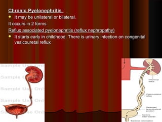 Chronic PyelonephritisChronic Pyelonephritis
 It may be unilateral or bilateral.It may be unilateral or bilateral.
It occurs in 2 formsIt occurs in 2 forms
Reflux associated pyelonephritis (reflux nephropathy)Reflux associated pyelonephritis (reflux nephropathy)
 It starts early in childhood. There is urinary infection on congenitalIt starts early in childhood. There is urinary infection on congenital
vesicouretal refluxvesicouretal reflux
99
 