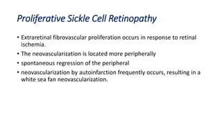 Proliferative Sickle Cell Retinopathy
• Extraretinal fibrovascular proliferation occurs in response to retinal
ischemia.
• The neovascularization is located more peripherally
• spontaneous regression of the peripheral
• neovascularization by autoinfarction frequently occurs, resulting in a
white sea fan neovascularization.
 
