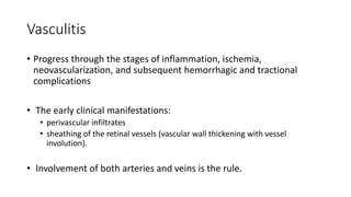 Vasculitis
• Progress through the stages of inflammation, ischemia,
neovascularization, and subsequent hemorrhagic and tractional
complications
• The early clinical manifestations:
• perivascular infiltrates
• sheathing of the retinal vessels (vascular wall thickening with vessel
involution).
• Involvement of both arteries and veins is the rule.
 