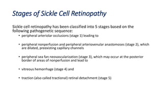 Stages of Sickle Cell Retinopathy
Sickle cell retinopathy has been classified into 5 stages based on the
following pathogenetic sequence:
• peripheral arteriolar occlusions (stage 1) leading to
• peripheral nonperfusion and peripheral arteriovenular anastomoses (stage 2), which
are dilated, preexisting capillary channels
• peripheral sea fan neovascularization (stage 3), which may occur at the posterior
border of areas of nonperfusion and lead to
• vitreous hemorrhage (stage 4) and
• traction (also called tractional) retinal detachment (stage 5)
 