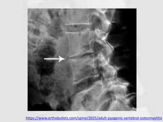 https://www.orthobullets.com/spine/2025/adult-pyogenic-vertebral-osteomyelitis
 
