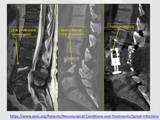 https://www.aans.org/Patients/Neurosurgical-Conditions-and-Treatments/Spinal-Infections
 