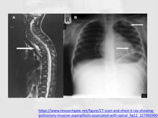 https://www.researchgate.net/figure/CT-scan-and-chest-X-ray-showing-
pulmonary-invasive-aspergillosis-associated-with-spinal_fig12_227992990
 