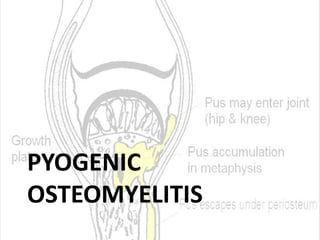 PYOGENIC
OSTEOMYELITIS
 
