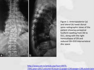 http://www.jotr.in/article.asp?issn=0975-
7341;year=2017;volume=9;issue=2;spage=134;epage=138;aulast=Jain
Figure 1: Anteroposterior (a)
and lateral (b) lower dorsal
spine radiographic views of the
patient showing paraspinal
fusiform swelling from D6 to
D11, along with the right
hemicollapse of D9 and
reduced D9–D10 intervertebral
disc space
 