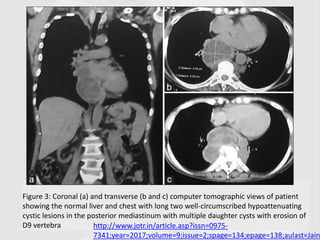 Figure 3: Coronal (a) and transverse (b and c) computer tomographic views of patient
showing the normal liver and chest with long two well-circumscribed hypoattenuating
cystic lesions in the posterior mediastinum with multiple daughter cysts with erosion of
D9 vertebra http://www.jotr.in/article.asp?issn=0975-
7341;year=2017;volume=9;issue=2;spage=134;epage=138;aulast=Jain
 