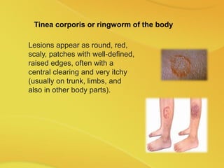 Tinea corporis or ringworm of the body
Lesions appear as round, red,
scaly, patches with well-defined,
raised edges, often with a
central clearing and very itchy
(usually on trunk, limbs, and
also in other body parts).
 