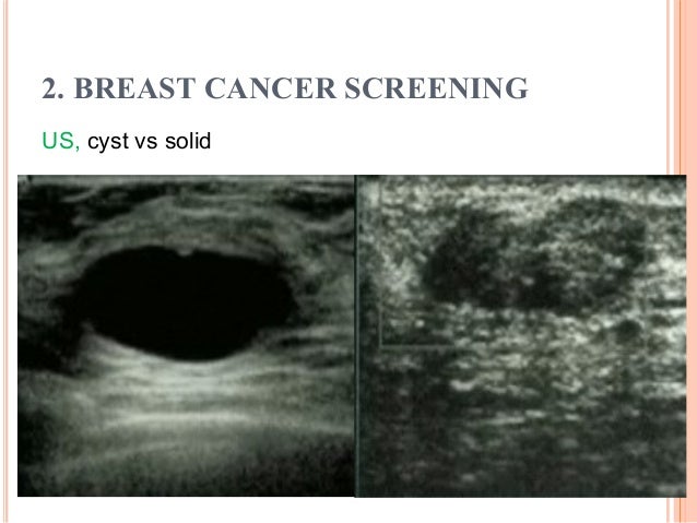 đo Thị Ngọc Hiếu Breast Cancer Epidemiology And Screening In Vie