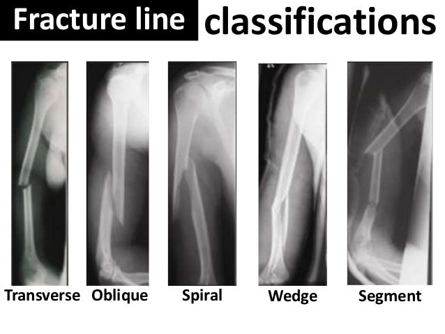 fracture shaft of humerus