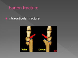  Intra-articular fracture
 