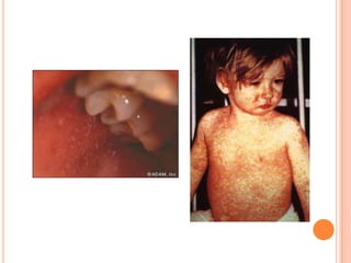 Which antiviral drugs are effective for the treatment of influenza virus infection? What are the targets & mechanisms of action of these drugs?