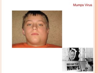 Induce cell-to-cell fusion  multinucleated giant cellsEnvelope Spikes of Paramyxoviruses1The measles and mumps fusion proteins are also hemolysins.2In mumps and parainfluenza viruses, the hemagglutinin and neuraminidase are on the same spike and the fusion protein is on a different spike.