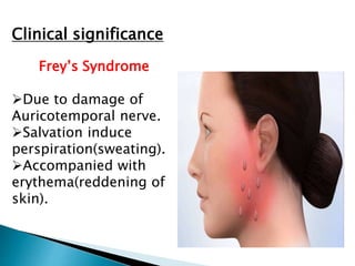 Clinical significance
Frey’s Syndrome
Due to damage of
Auricotemporal nerve.
Salvation induce
perspiration(sweating).
Accompanied with
erythema(reddening of
skin).
 