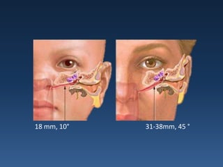 18 mm, 10°   31-38mm, 45 °
 