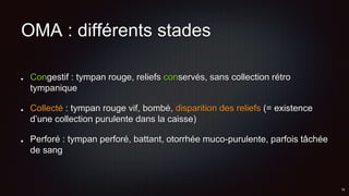 OMA : différents stades
Congestif : tympan rouge, reliefs conservés, sans collection rétro
tympanique
Collecté : tympan rouge vif, bombé, disparition des reliefs (= existence
d’une collection purulente dans la caisse)
Perforé : tympan perforé, battant, otorrhée muco-purulente, parfois tâchée
de sang
 