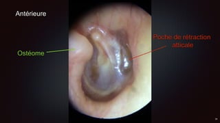 Ostéome
Antérieure
Poche de rétraction
atticale
 