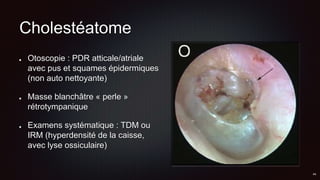 Cholestéatome
Otoscopie : PDR atticale/atriale
avec pus et squames épidermiques
(non auto nettoyante)
Masse blanchâtre « perle »
rétrotympanique
Examens systématique : TDM ou
IRM (hyperdensité de la caisse,
avec lyse ossiculaire)
 