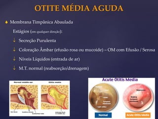 OTITE MÉDIA AGUDA
 Membrana Timpânica Abaulada
Estágios (em qualquer direção):
 Secreção Purulenta
 Coloração Âmbar (efusão rosa ou mucoide) – OM com Efusão / Serosa
 Níveis Líquidos (entrada de ar)
 M.T. normal (reabsorção/drenagem)
 