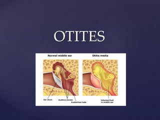OTITES
 