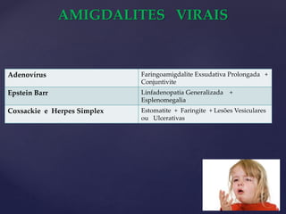 AMIGDALITES VIRAIS
Adenovírus Faringoamigdalite Exsudativa Prolongada +
Conjuntivite
Epstein Barr Linfadenopatia Generalizada +
Esplenomegalia
Coxsackie e Herpes Simplex Estomatite + Faringite + Lesões Vesiculares
ou Ulcerativas
 