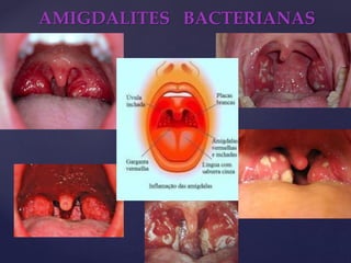 AMIGDALITES BACTERIANAS
 