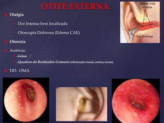 OTITE EXTERNA
 Otalgia
 Dor Intensa bem localizada
 Otoscopia Dolorosa (Edema CAE)
 Otorreia
 Ausência:
 Febre /
 Quadros de Resfriados Comuns (obstrução nasal, coriza, tosse)
 DD: OMA
 