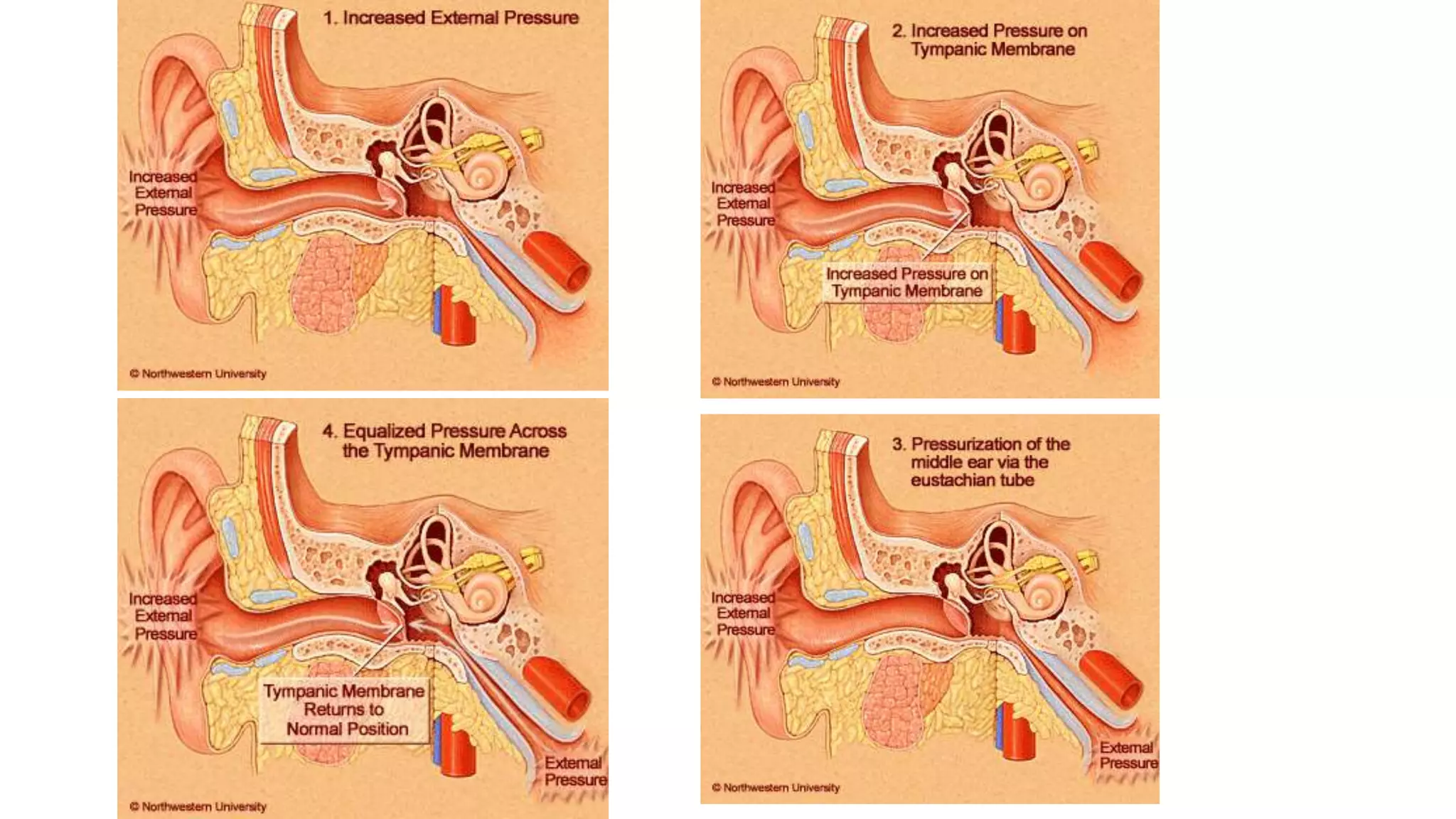 Otitic barotrauma by Dr Manohar Suryawanshi ENT resident INHS Asvini