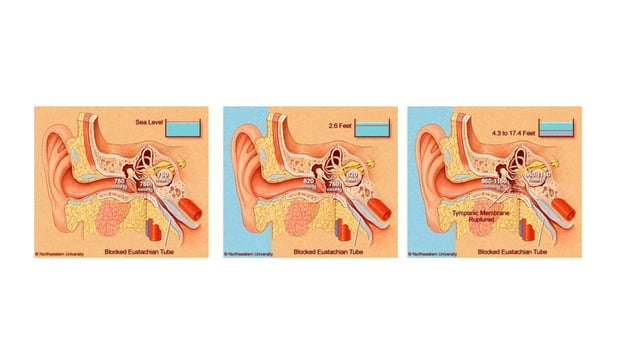Otitic barotrauma by Dr Manohar Suryawanshi ENT resident INHS Asvini ...