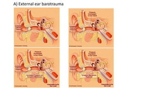 A) External ear barotrauma
 