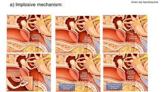 a) Implosive mechanism:
Inner ear barotrauma
 