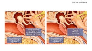 Inner ear barotrauma
 