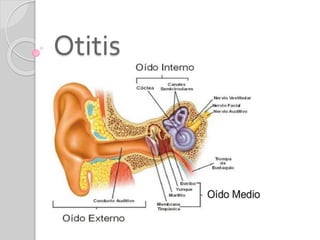 Otitis
 