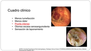 Cuadro clínico
• Menos tumefacción
• Menos dolor
• Prurito intenso
• Otorrea escasa serosanguinolenta
• Sensación de taponamiento
SEORL Sociedad Española de Otorrinolaringología y Patología Cérvico-Facial, OTORRINOLARINGOLOGÍA Manual clínico, Editorial
Panamericana, España, 2011
 