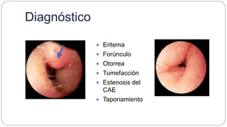 Diagnóstico
 Eritema
 Forúnculo
 Otorrea
 Tumefacción
 Estenosis del
CAE
 Taponamiento
 