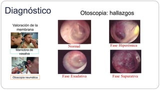 Diagnóstico Otoscopia: hallazgos
Maniobra de
vasalva
Otoscopia neumática
Valoración de la
membrana
timpánica
 
