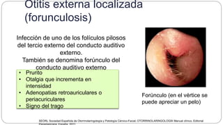 Otitis externa localizada
(forunculosis)
• Prurito
• Otalgia que incrementa en
intensidad
• Adenopatias retroauriculares o
periacuriculares
• Signo del trago
Forúnculo (en el vértice se
puede apreciar un pelo)
Infección de uno de los folículos pilosos
del tercio externo del conducto auditivo
externo.
También se denomina forúnculo del
conducto auditivo externo
SEORL Sociedad Española de Otorrinolaringología y Patología Cérvico-Facial, OTORRINOLARINGOLOGÍA Manual clínico, Editorial
 