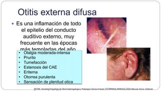 Otitis externa difusa
 Es una inflamación de todo
el epitelio del conducto
auditivo externo, muy
frecuente en las épocas
más templadas del año.
• Otalgia moderada-intensa
• Prurito
• Tumefacción
• Estenosis del CAE
• Eritema
• Otorrea purulenta
• Sensación de plenitud otica
SEORL Sociedad Española de Otorrinolaringología y Patología Cérvico-Facial, OTORRINOLARINGOLOGÍA Manual clínico, Editorial
 