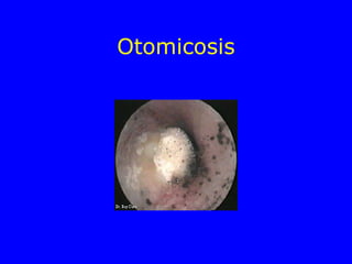 Otomicosis 