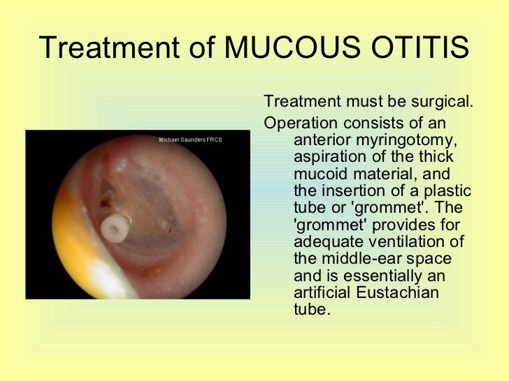 Otitis part 3