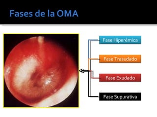 Fase Trasudado Fase Exudado Fase Supurativa Fase Hiperémica 