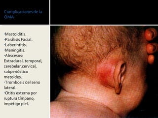Mastoiditis. Parálisis Facial. Laberintitis. Meningitis. Abscesos: Extradural, temporal, cerebelar,cervical, subperióstico matoides. Trombosis del seno lateral. Otitis externa por ruptura tímpano, impétigo piel. 