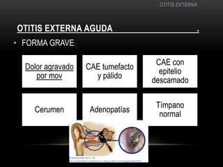 OTITIS EXTERNA AGUDa                                     .OTITIS EXTERNAFORMA GRAVE:Tumefacción del CAE www.medicalook.com/diseases_images/otitis-externa.jpg&imgrefurl